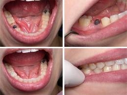Dental Implants Smile Like Never Before