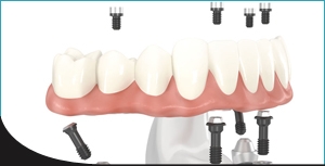 Dental Technician Glasgow Offer All Kinds of Denture Services