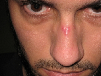 Fractured nose