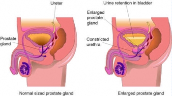 Living with Prostate Discomfort